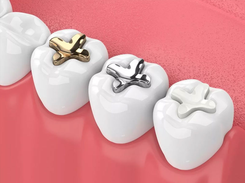 Composite Dental Filling in Lucknow