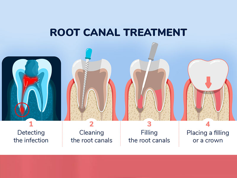 Root Canal Treatment in Lucknow