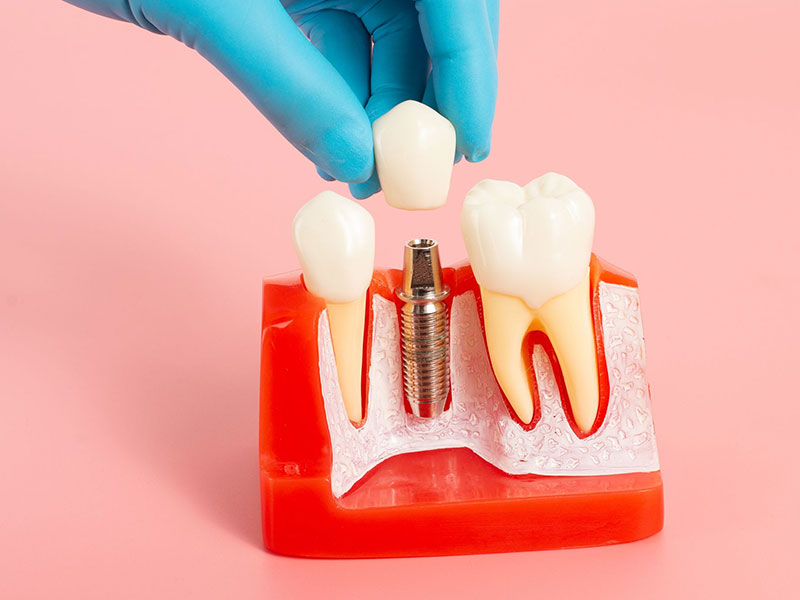 best dental implant in Lucknow